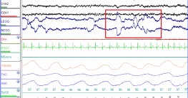 Aufnahme eines Schlaflabor-Patienten im REM-Schlaf